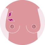 Symptome_Sein_Douleur_persistante